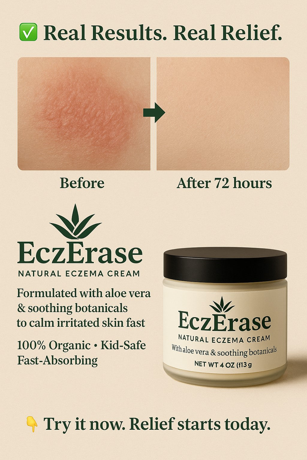 EczErase – Natural Eczema Cream for Kids, Babies & Adults